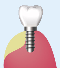 고난도 임플란트