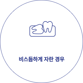 사랑니 발치 형태