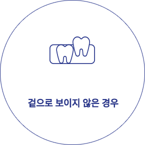 사랑니 발치 형태